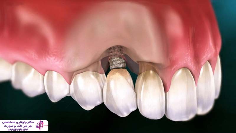 ایمپلنت فوری یک روزه