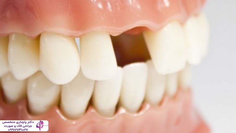 ایمپلنت فوری یک روزه