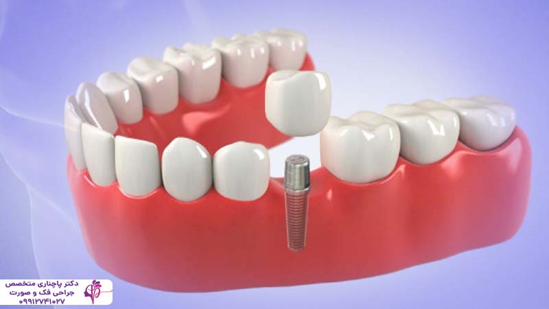 ایمپلنت فوری یک روزه