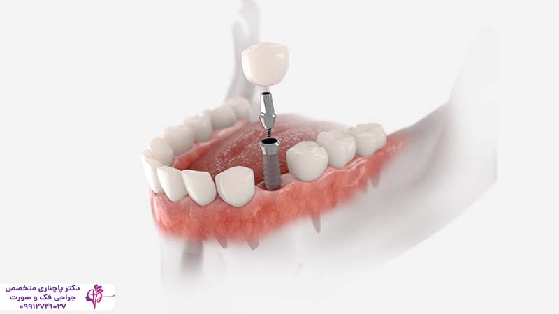 ایمپلنت فوری یک روزه
