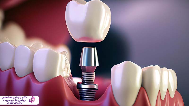 ایمپلنت فوری یک روزه