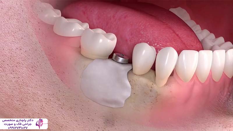 ایمپلنت فوری یک روزه