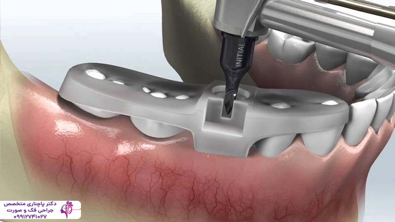 ایمپلنت فوری یک روزه