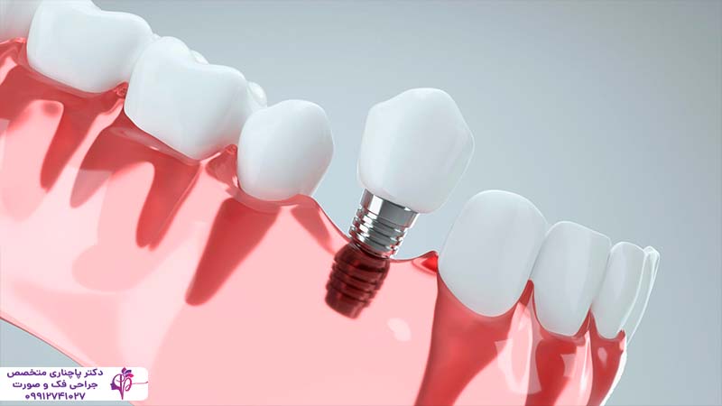 ایمپلنت فوری یک روزه