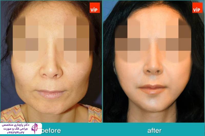 جراحی وی لاین 