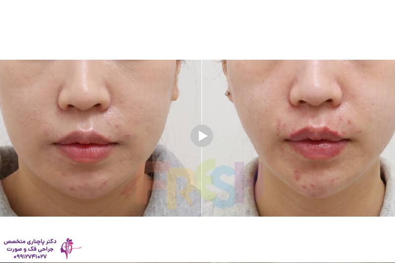 جراحی وی لاین 