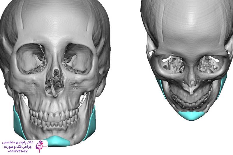 جراحی فک وی لاین 