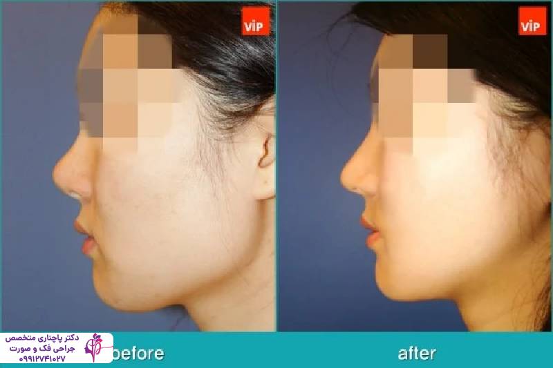 جراحی فک وی لاین 