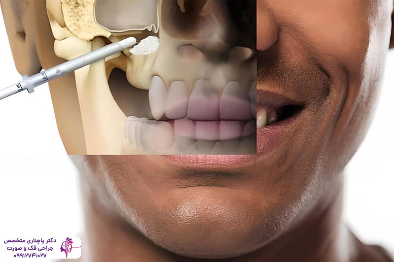 تفاوت سینوس لیفت باز و بسته