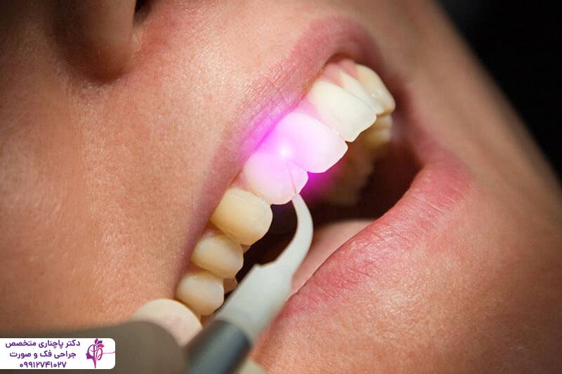 جراحی دندان عقل با لیزر