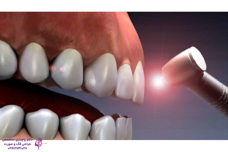 جراحی دندان عقل با لیزر