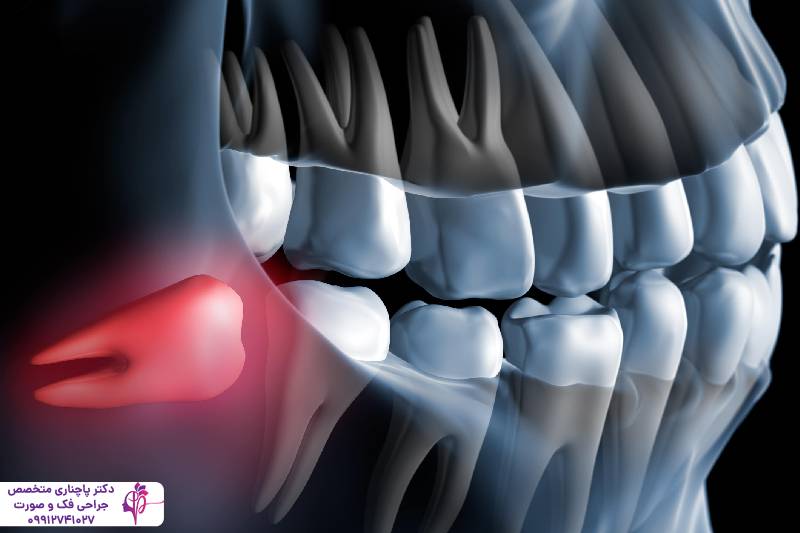 جراحی دندان عقل با لیزر