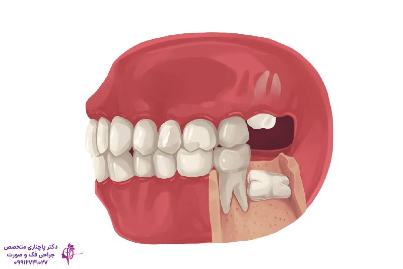 جراحی دندان عقل با لیزر