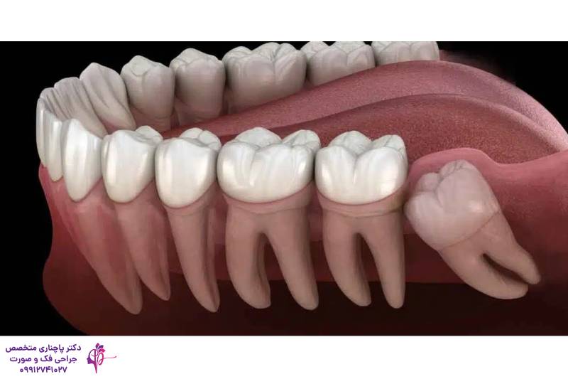 جراحی دندان عقل با لیزر