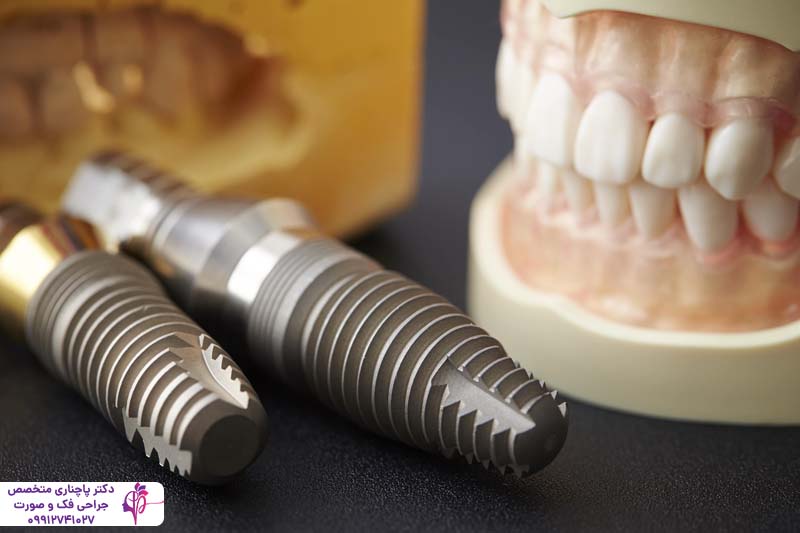 ایمپلنت سرامیکی یا پایه تیتانیومی