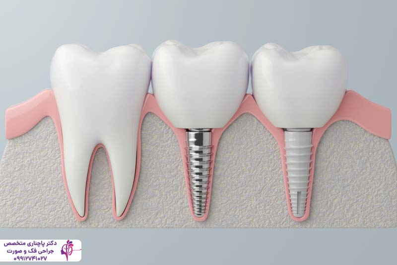 ایمپلنت سرامیکی یا پایه تیتانیومی
