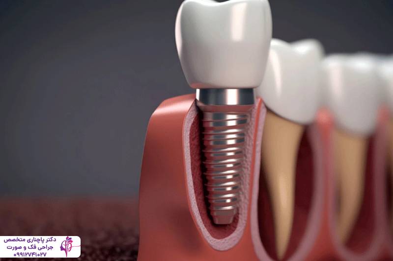 مقایسه پروتز و ایمپلنت دندان