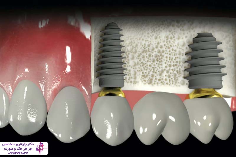 ایمپلنت سرامیکی یا پایه تیتانیومی