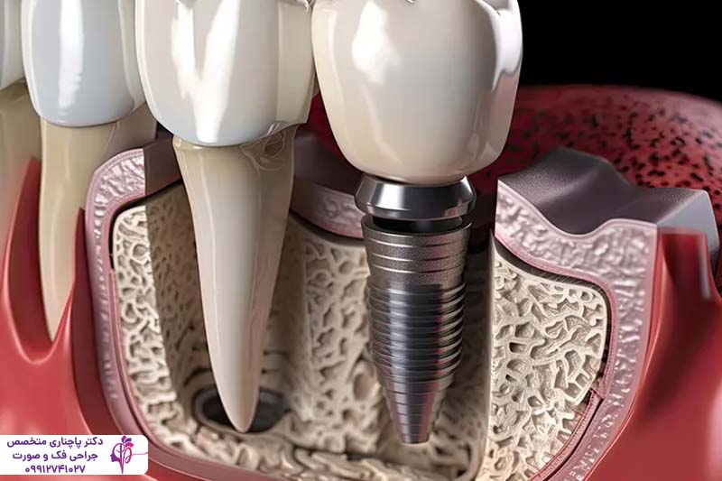 افتادن ایمپلنت داخل سینوس