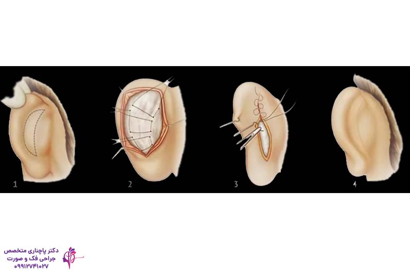 هزینه جراحی زیبایی گوش در تهران