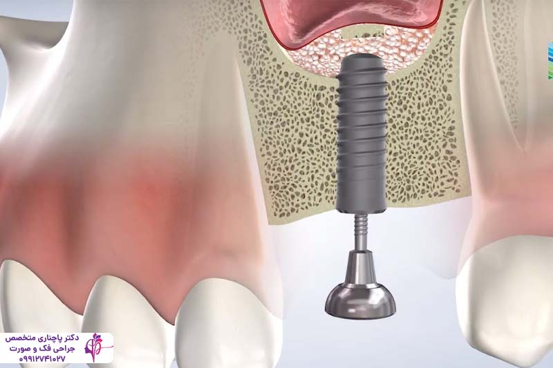 پیوند استخوان فک برای ایمپلنت
