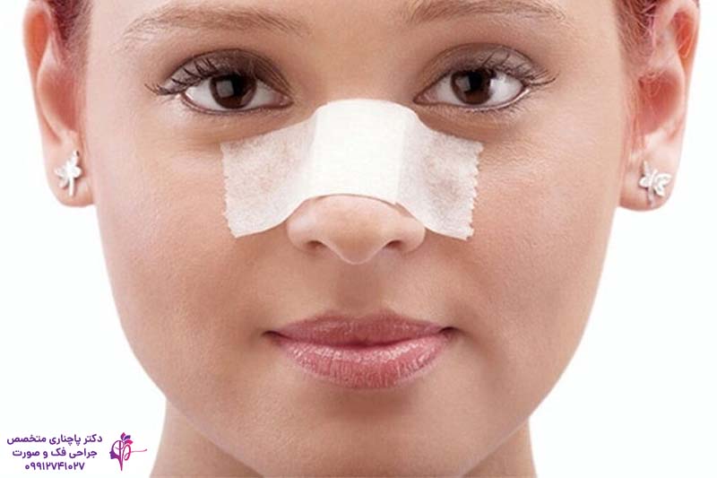 جراحی بینی گوشتی با غضروف ضعیف