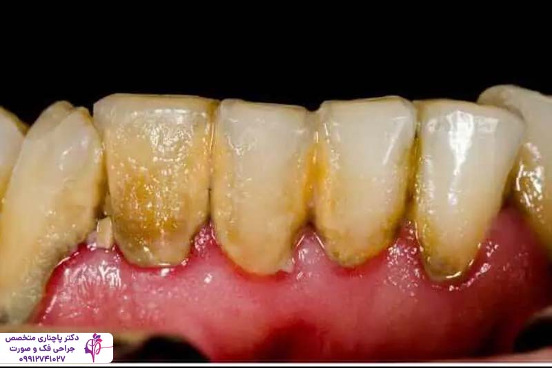 درمان بیماریهای لثه قبل از ایمپلنت