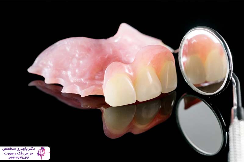 مقایسه فلیپر و ایمپلنت دندان