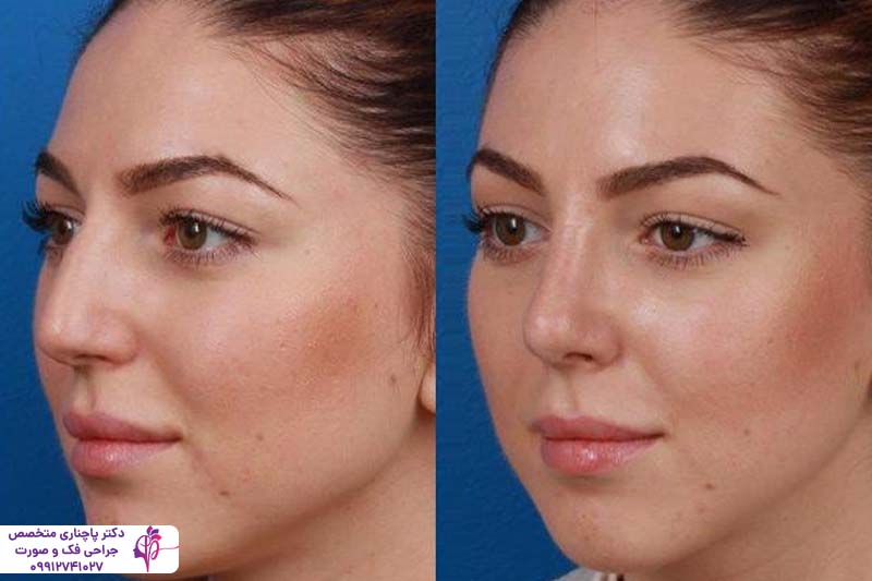 چسب زدن بینی بعد از عمل راینوپلاستی