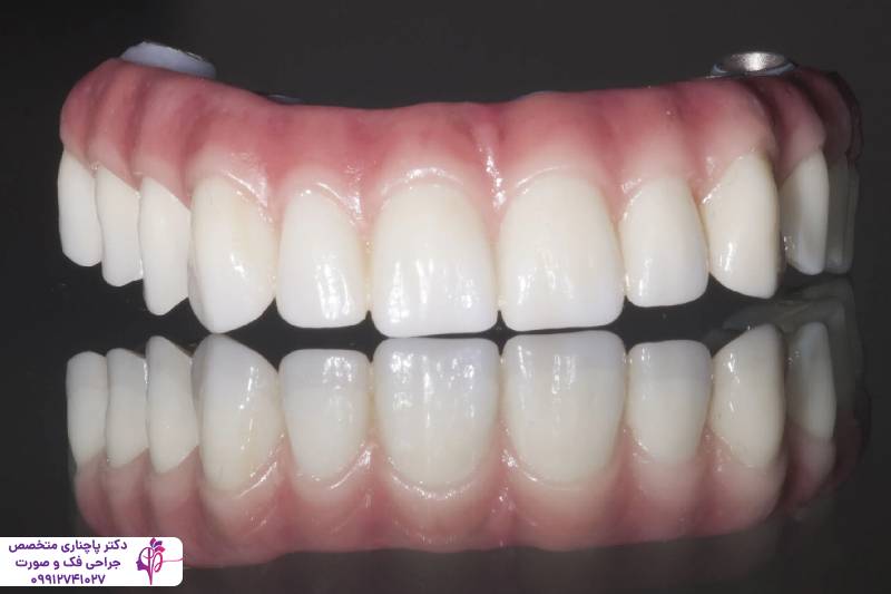 مقایسه پروتز و ایمپلنت دندان