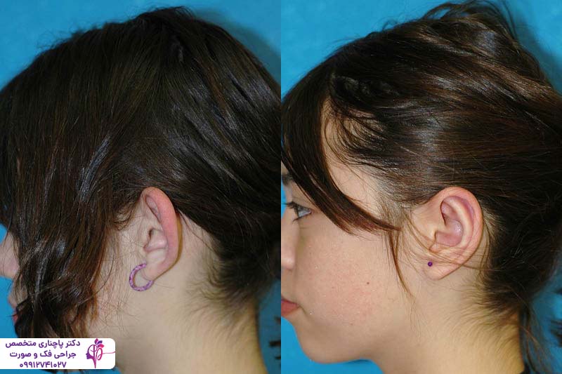 هزینه جراحی زیبایی گوش در تهران