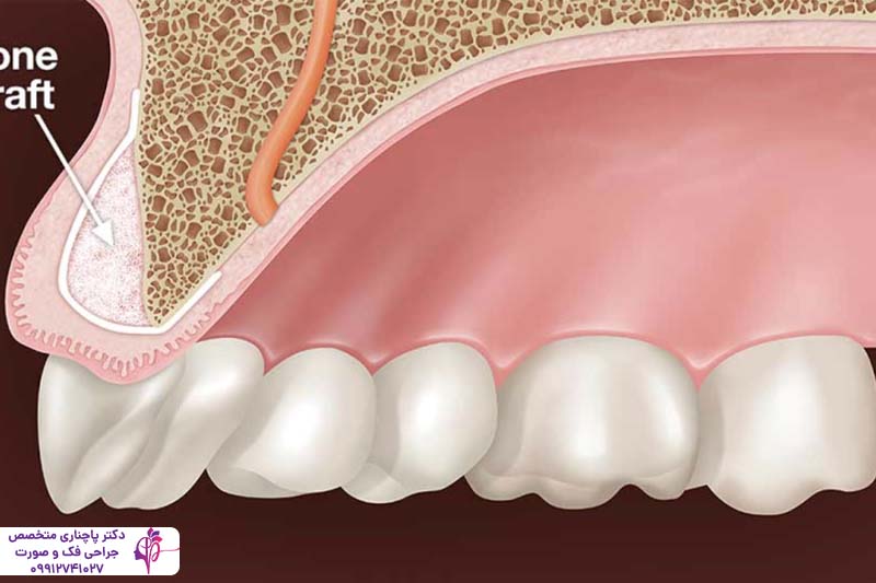 پیوند استخوان صورت