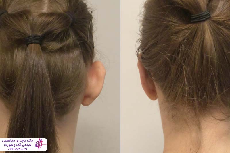 هزینه جراحی زیبایی گوش در تهران