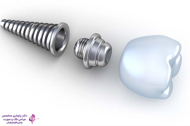ایمپلنت سرامیکی یا پایه تیتانیومی