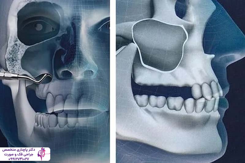 افتادن ایمپلنت داخل سینوس