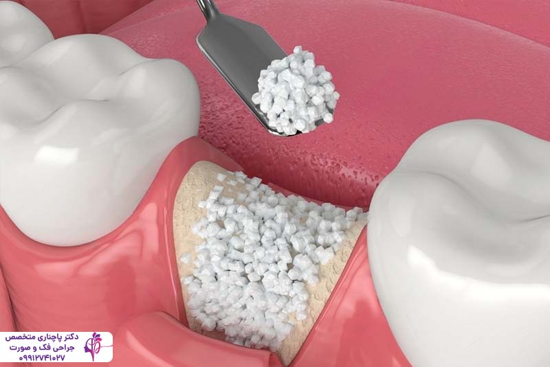 پیوند استخوان فک برای ایمپلنت