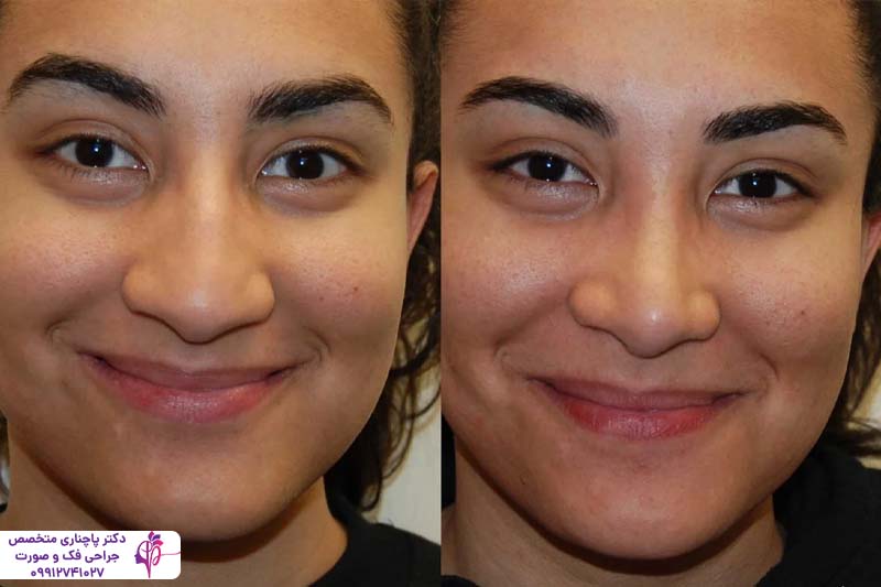 جراحی بینی گوشتی با غضروف ضعیف