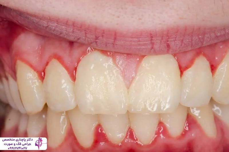 درمان بیماریهای لثه قبل از ایمپلنت
