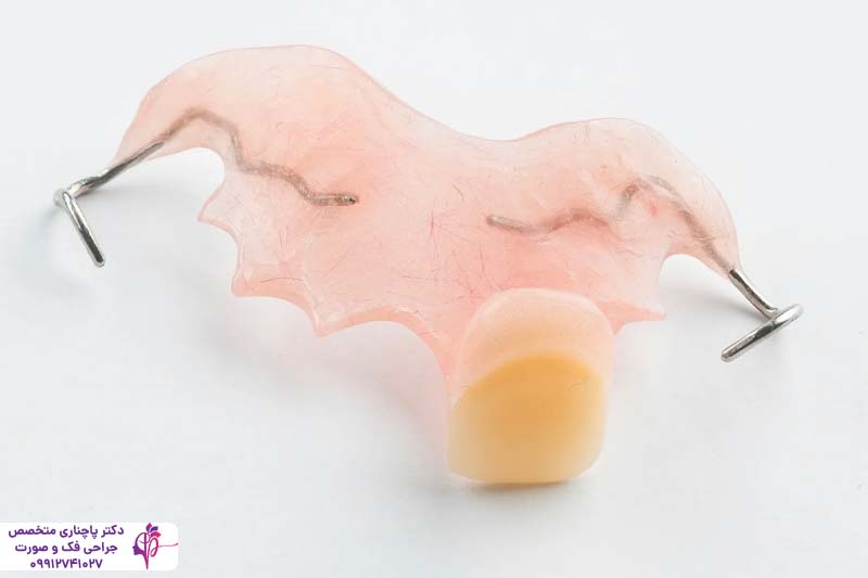 مقایسه فلیپر و ایمپلنت دندان