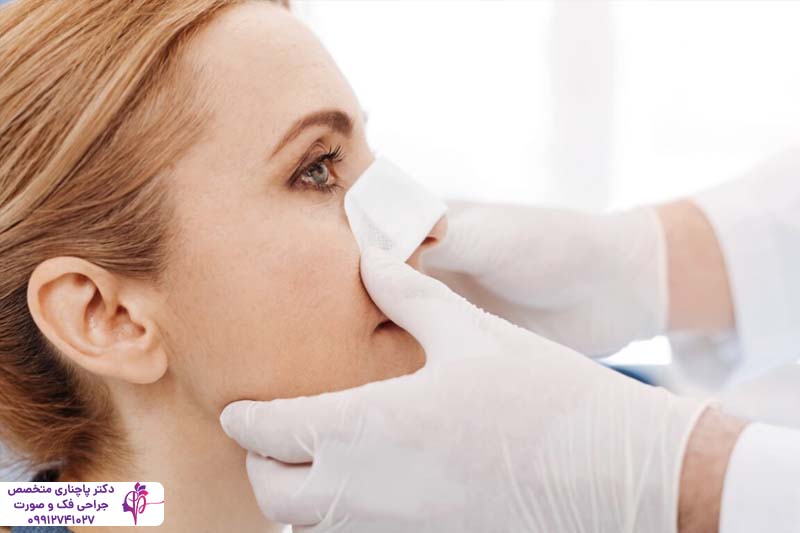 چسب زدن بینی بعد از عمل راینوپلاستی