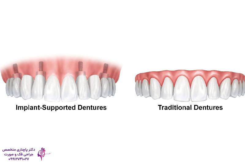مقایسه پروتز و ایمپلنت دندان