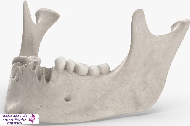 تحلیل استخوان فک