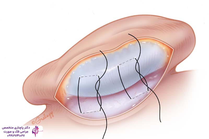 هزینه جراحی زیبایی گوش در تهران
