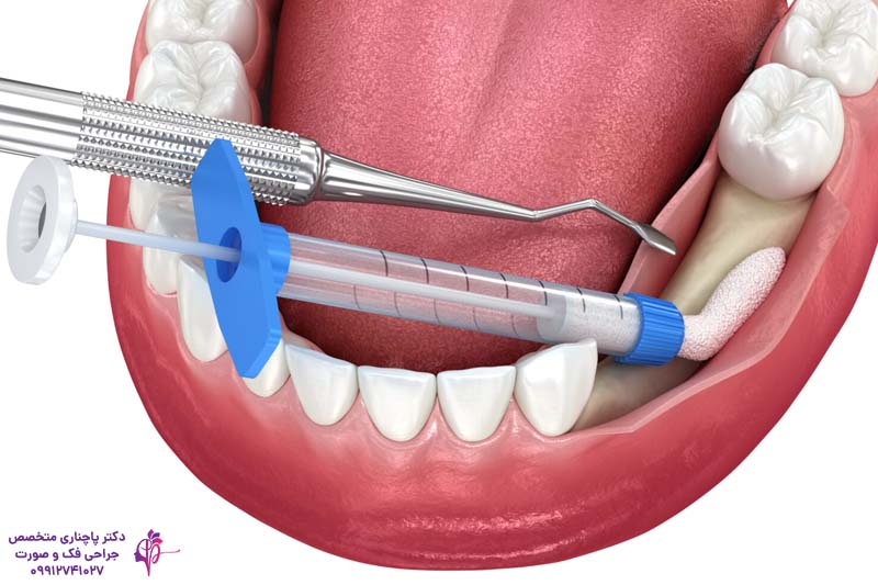 پیوند استخوان صورت