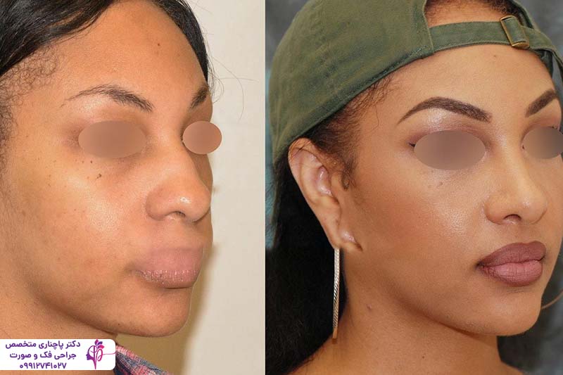 جراحی بینی گوشتی با غضروف ضعیف