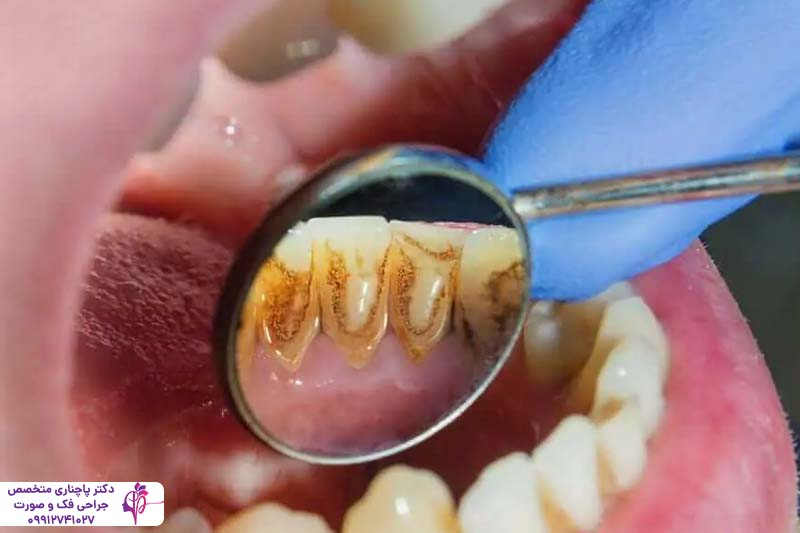 درمان بیماریهای لثه قبل از ایمپلنت