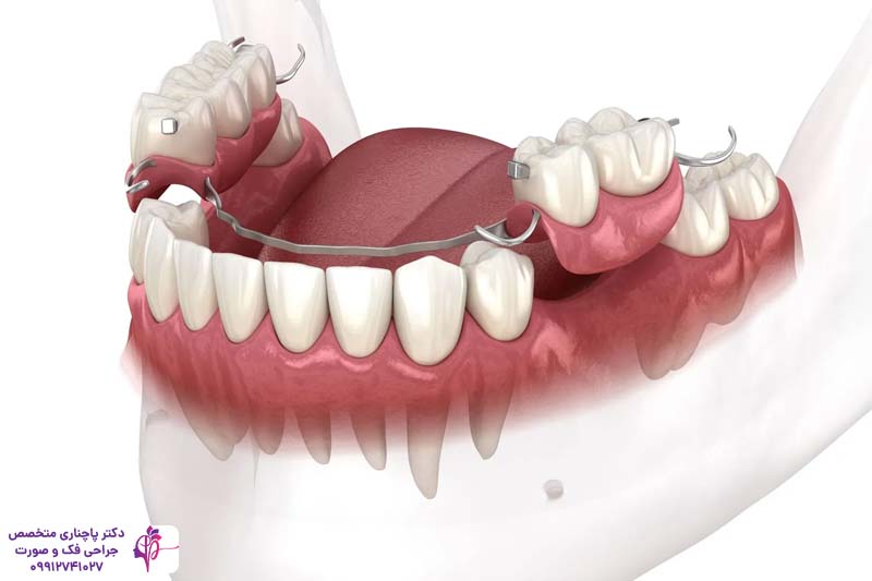 مقایسه فلیپر و ایمپلنت دندان