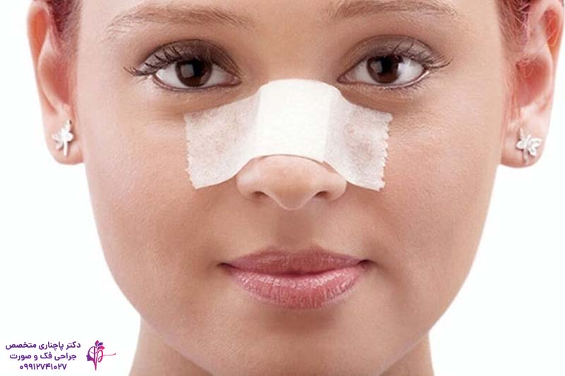 چسب زدن بینی بعد از عمل راینوپلاستی