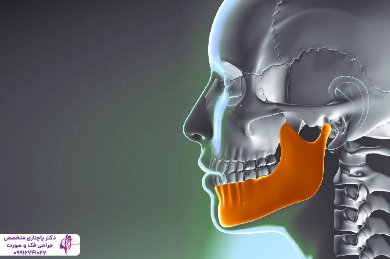 تحلیل استخوان فک
