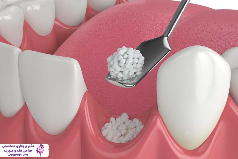 پیوند استخوان فک برای ایمپلنت